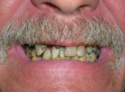 All on 4 Teeth in a day with dental implants all on 4