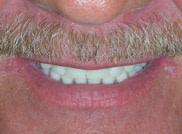 Teeth in a day treatment Dr. Augustine teeth in a day