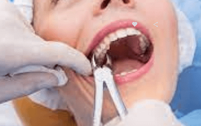 5 Reasons for Tooth Extractions in Phoenix