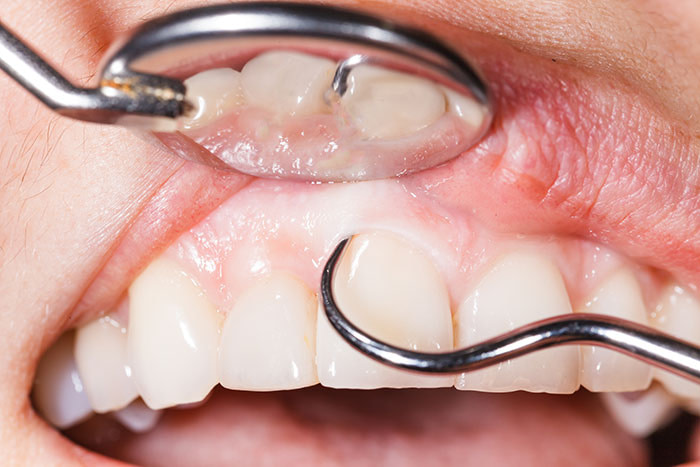 Periodontal Treatments scaling and root planing