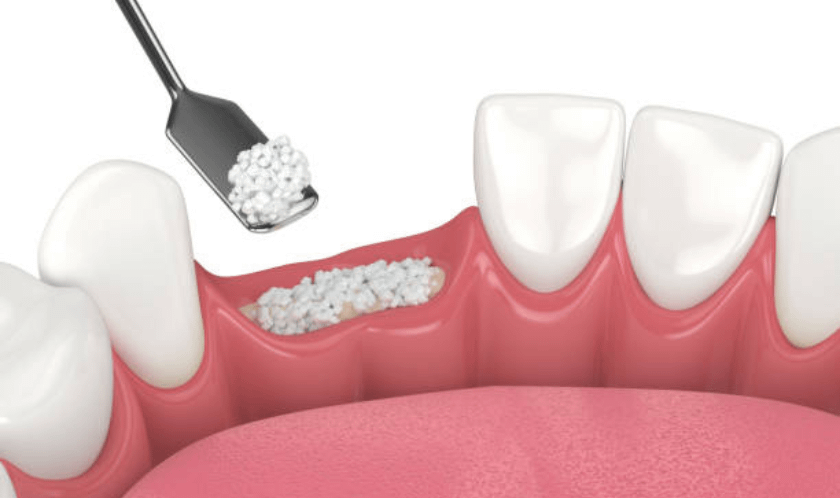 How Bone Grafting Can Improve The Dental Implants Process