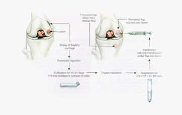 kneecartilagerepair-image2 knee cartilage repair