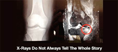 subchondroplasty-image1 subchondroplasty xray