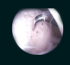 knee cartilage image