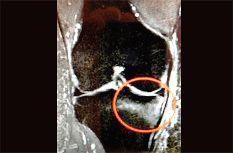 subchondroplasty image