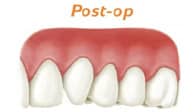 Post-op gum grafts