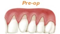 Pre-op gum grafting