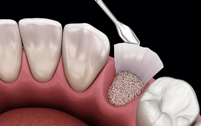 What are the Different Types of Bone Grafts & Their Benefits To a Patient?