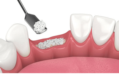 How Bone Grafting Can Improve The Dental Implants Process?