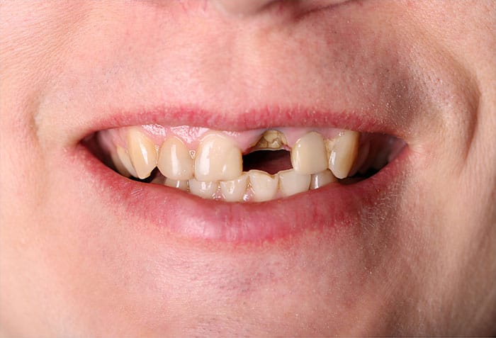 missing front tooth before dental implants