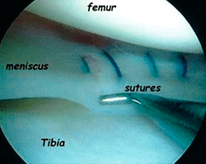 knee arthroscopy