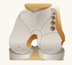kneecartilagerepair-image3 kneecartilagerepair diagram