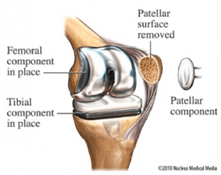 totalkneereplacementsurgery