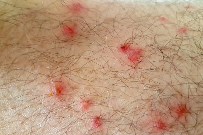 human skin flea allergy